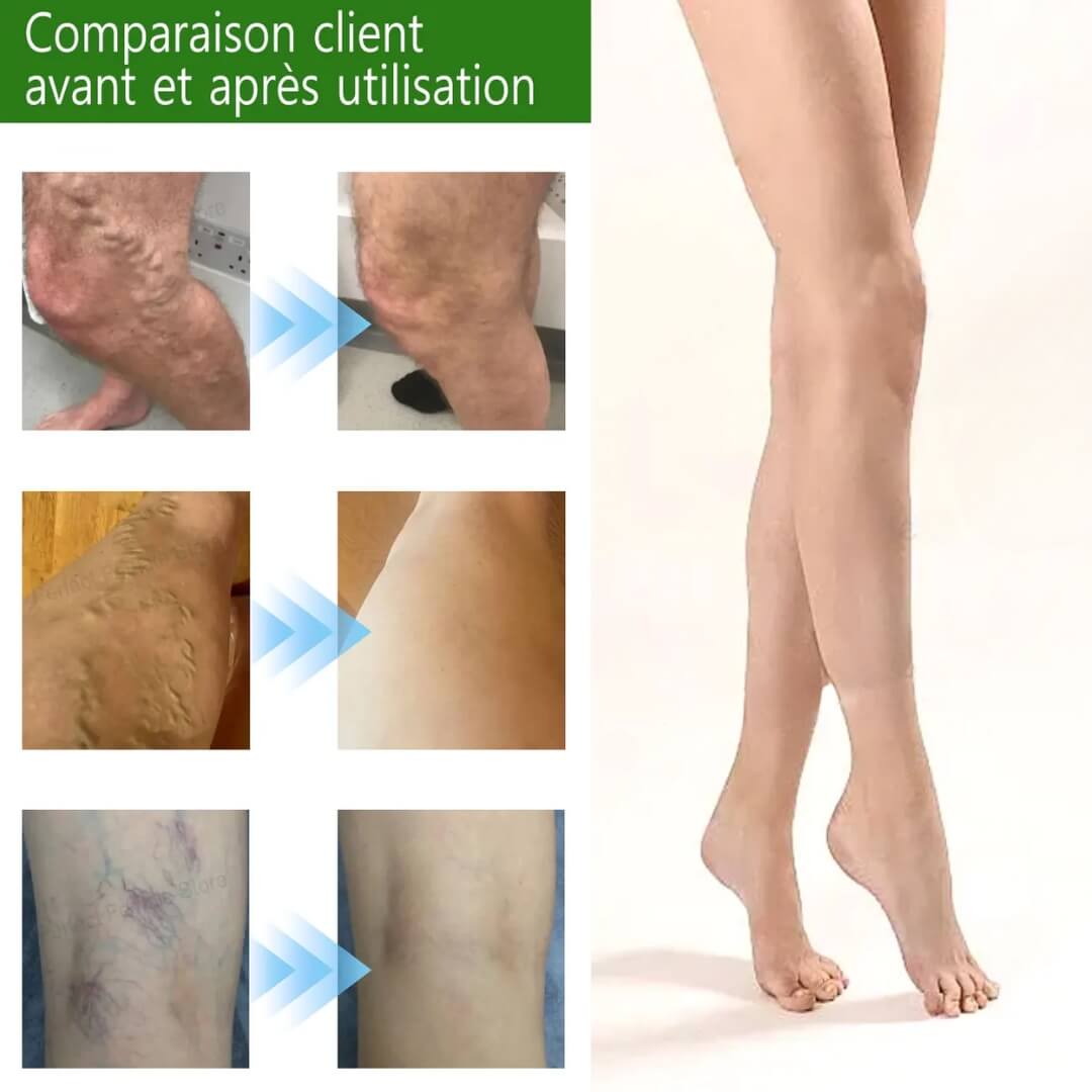 VarixCare Laser® – Traitement des varices 3ᵉ génération