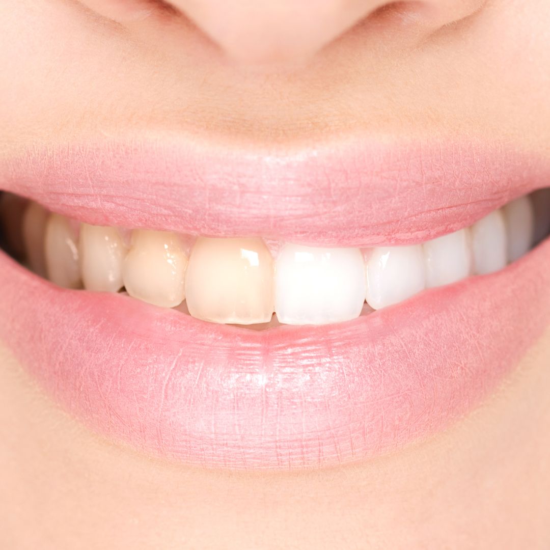 Hydropulseur - Appareil de détartrage dentaire haute performance