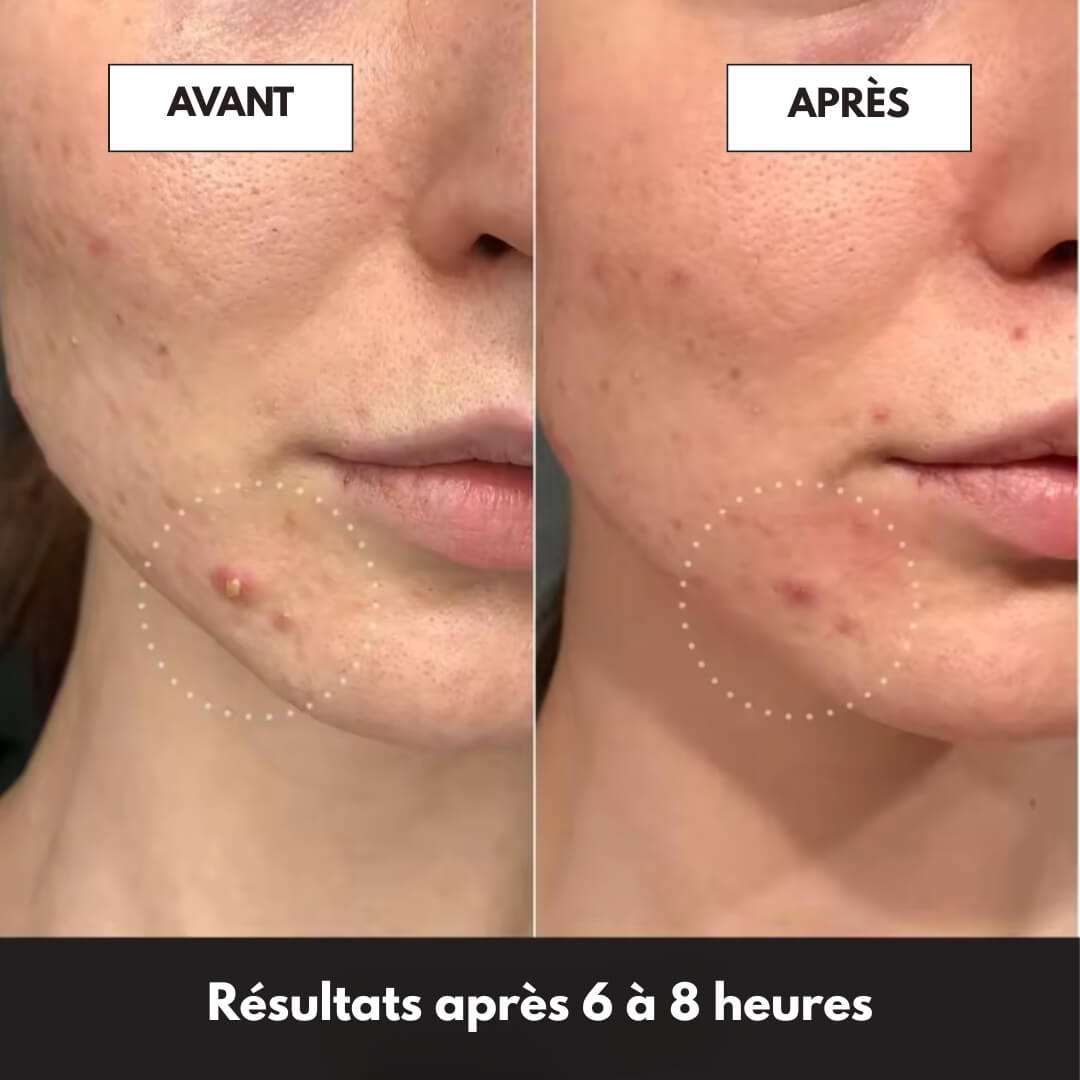 Patchs anti-boutons invisibles  – 144 patchs anti-acné professionnels